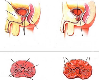 normalna prostata i przewlekłe zapalenie gruczołu krokowego